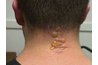 Result of a blister beetle smashed on the back of the neck.