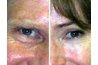 These people are the same age, but have genetically different eye contours