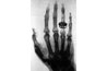 Roentgen's wife's hand