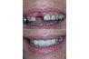 Good partial dentures are impossible to distinguish from your natural teeth.
