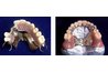 Partial Dentures
