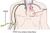 TYPICAL PICC LINE