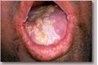 Candida overgrowth in the mouth