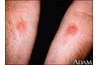 Candida on the arms