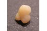 A typical tonsil stone or tonsillolith