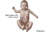 Wilms Tumor, courtesy of google.com