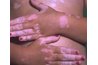 Vitiligo