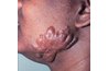 Keloids