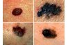 Moles
