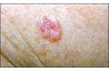Basal cell