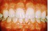 Gingivitis, the first stage of gum disease (photo courtesy of curevaginosis.com)