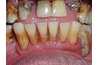 Severe case of gum disease (photo courtesy of drfaithbuilt.com)