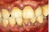 Nicotine stains on teeth are unsightly and bad for oral health.