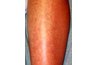 Urticaria on the shin, public domain, http://commons.wikimedia.org/wiki/File:Urticaria_2.jpg