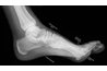 An X-Ray may be required to diagnosis the underlying cause of foot pain.