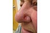 basal cell carcinoma
