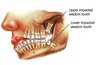Wisdom teeth that grow in at an angle generally need to be extracted (WebMD)