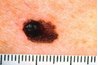 Malignant Melanoma