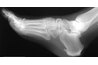 Because of all the activity the normal heel receives, a spur here can be incredibly detrimental to one's way of life. Heel spur exercises will help moderate the pain, but seeing a physician is essential.