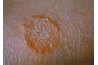 Ringworms are caused by a fungus--not worms.