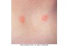Chicken pox is characterized by the tiny "dewdrop" pustule in the center of each pox.