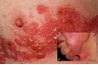 Shingles are caused by the varicella-roster virus.