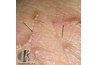 Scabies are caused by mites that burrow underneath the skin.