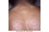 Pityriasis rosea causes a distinctive oval rash that spreads over time.