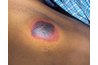 Development of Bed Sore
