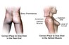 Injection site on butt or shoulder