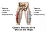 Thigh injection site