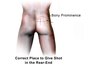 Gluteal injection site