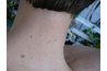What Typical Moles May Look Like