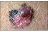 What an atypical mole may look like.