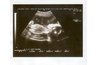 Fetus is looking up at the probe, head is on the right.