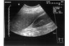 Longitudinal view with white dot. Kidney is on the right, liver on left and diaphragm in between.