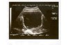 Full bladder with ovaries on either side at bottom of picture.
