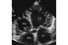 Four-chamber view with left ventricle (L.V.), right ventricle (R.V., left atrium (L.A.), and right atrium (R.A.)