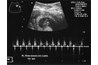 The doppler function allows you to measure the heartbeat.