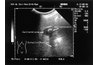 Gallbladder (dark circle) and gallstone (with comet tail shadow)