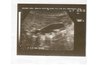 Gallbladder (dark) with many comet tail shadows representing stones