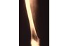 Tapeworm cysts in muscle.