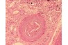 Cholesterol Emboli (Fatty Deposit) in Artery