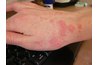 Scabies Rash (Wiki Commons)