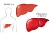 Normal and Inflamed Liver by Nucleus Medical Art, Inc: aurorhealthcare.org