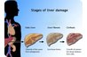 Stages of Liver Damage: nursingcrib.com