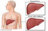 Cirrhosis of the Liver by Healthwise, Inc: health.com