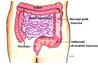 C-difff Colitis