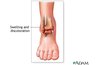 Anatomy of an ankle sprain
