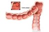 Polyps